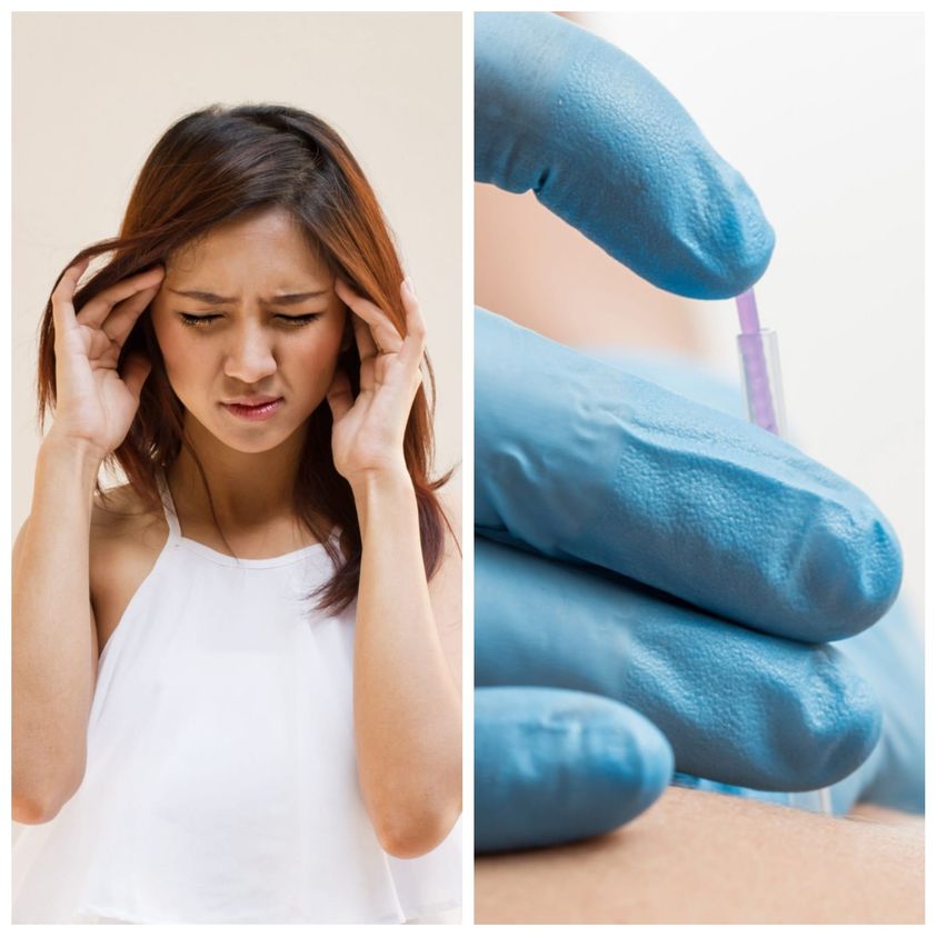 The dry needling course: Western acupuncture/dry needling for headaches